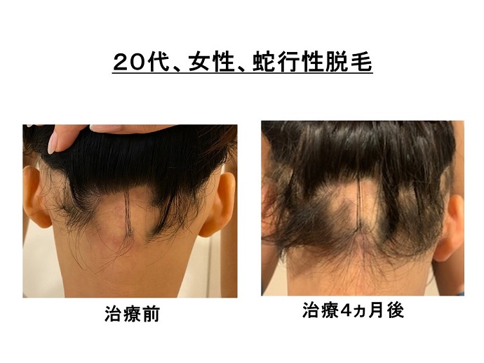 円形脱毛症　病院